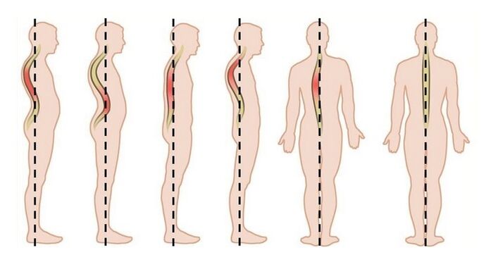 posturako nahasteak osteokondrosi torazikoaren kausa gisa